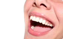 Faccette (veneers)