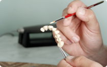 Ponti dentali Ponti dentali